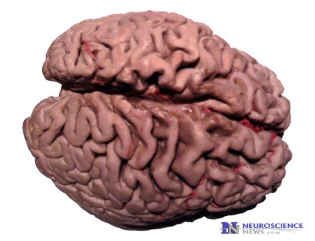 Image shows an alzheimer's brain.
